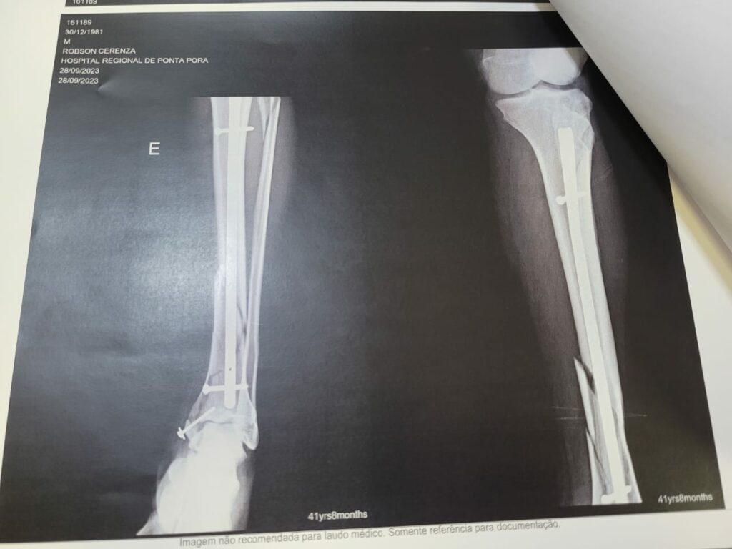 Depois de sofrer queda durante férias, pontaporanense passa por cirurgias em Ponta Porã Depois de sofrer queda durante férias, pontaporanense passa por cirurgias em Ponta Porã