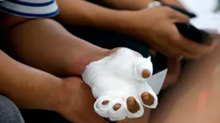 Quemaduras o amputaciones por petardos y su terrible impacto psicológico en niños Quemaduras o amputaciones por petardos y su terrible impacto psicológico en niños
