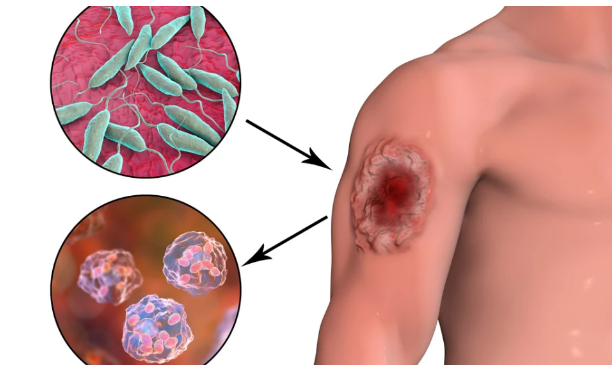 Aumento de casos de leishmaniasis en Paraguay: alertan sobre prevención y diagnóstico oportuno Aumento de casos de leishmaniasis en Paraguay: alertan sobre prevención y diagnóstico oportuno