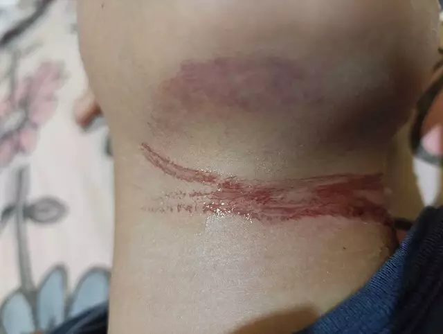 Menino de 10 anos tem pescoço ferido ao se enroscar num fio que estava solto na calçada Menino de 10 anos tem pescoço ferido ao se enroscar num fio que estava solto na calçada
