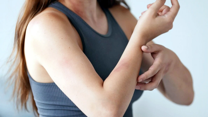 El susu’a: una infección frecuente que muchos no tratan a tiempo