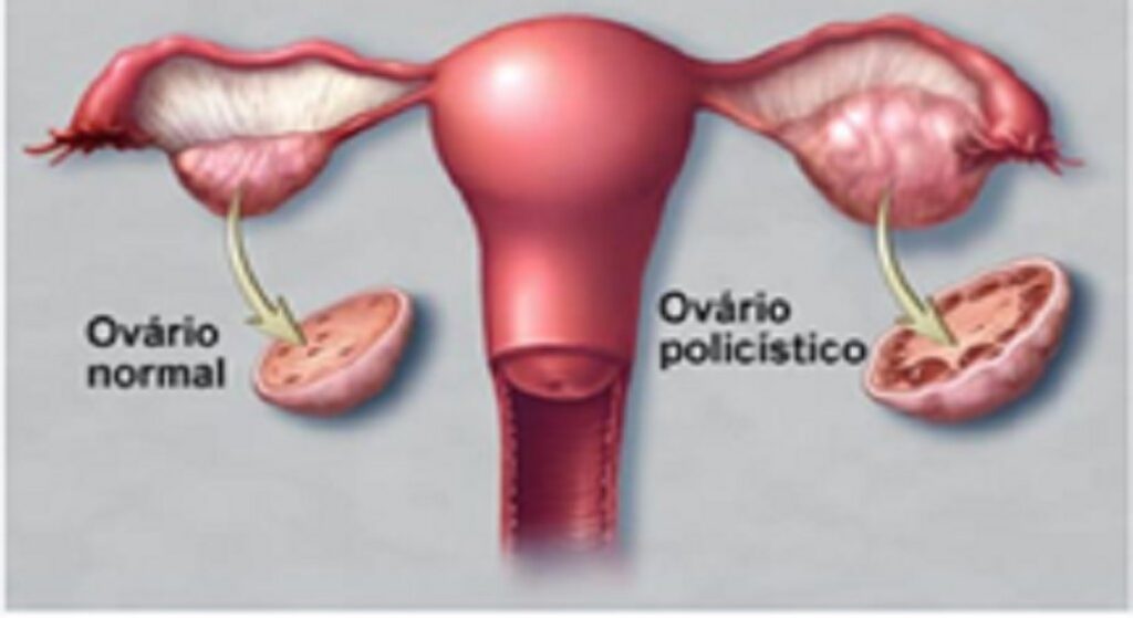Mês da Mulher: De SOP à Menopausa, os desafios da saúde feminina são temas de conscientização