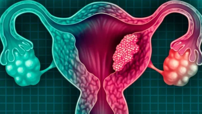 Cáncer de Cuello Uterino: “Lograr coberturas altas de vacunación (contra el VPH) es lo ideal en esta lucha”