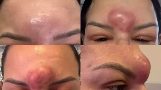 Bactéria que teria contaminado produtos Ypê já causou surto em hospital de MS Bactéria que teria contaminado produtos Ypê já causou surto em hospital de MS