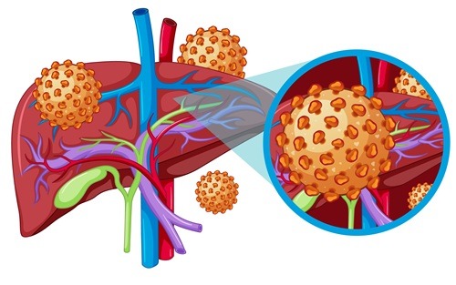Como as hepatites virais afetam seu fígado? 28.07- Dia Mundial de Luta contra as Hepatites Virais