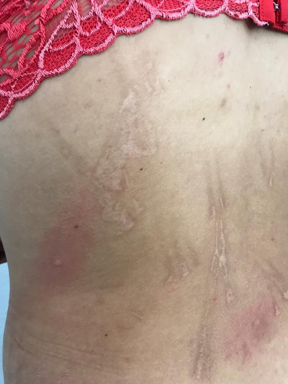 Vítima de tortura e cárcere mostrou hematomas feitos pelo companheiro em MS — Foto: Polícia Civil/Divulgação