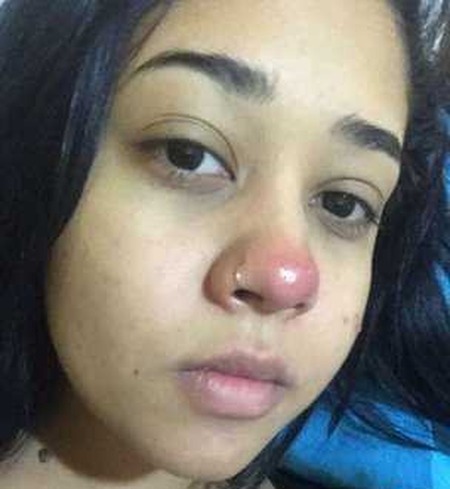 Um dos primeiros sintomas da infecção sofrida por Layane Dias foi uma 'bola vermelha' no nariz — Foto: Arquivo pessoal (via BBC)